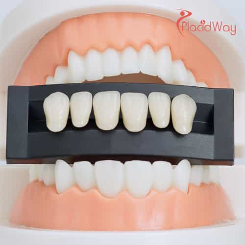 Why Kiwis are Choosing Thailand for Dental Veneers: A Comprehensive Guide